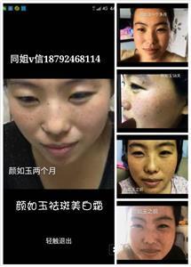 去斑美白要多少钱