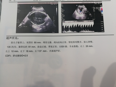 34周胎儿股骨长标准值