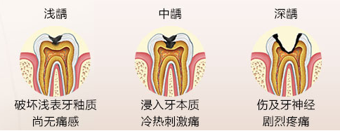 补牙需要多少费用
