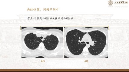 肺部结节怎么治疗
