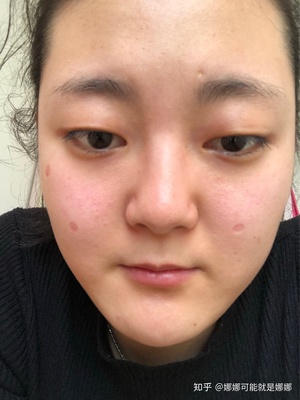 点痣用药水还是激光好