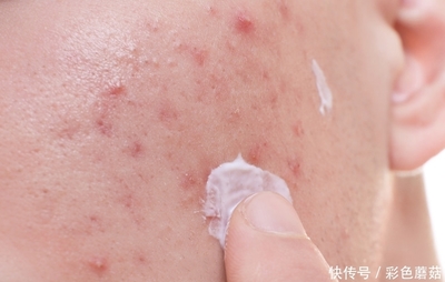 脸颊痘痘一直反复发作