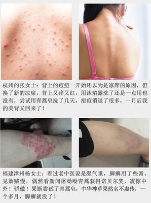 男人背上长痘痘用什么洗