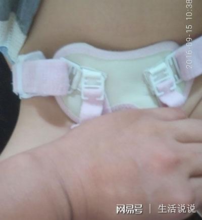 小孩疝气怎么治疗最好
