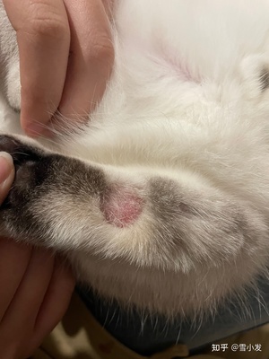 人长猫癣怎么治疗