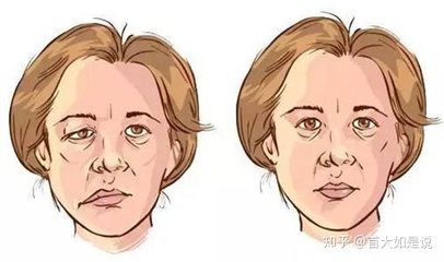 脸部麻木是怎么回事