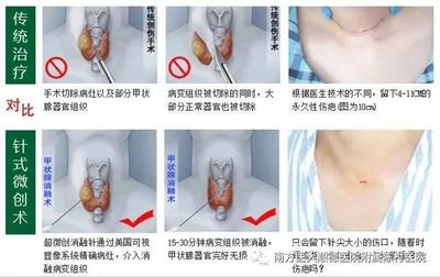 颈部结节怎么治疗