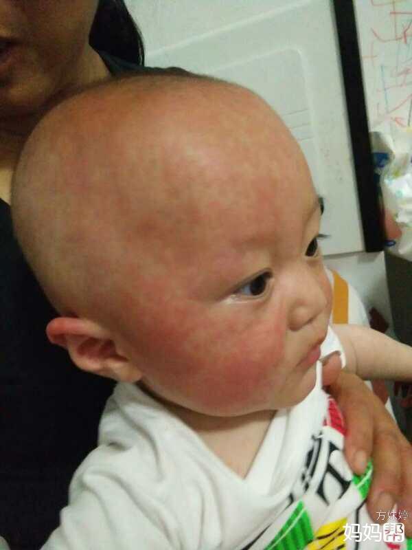 7个月的宝宝有点咳嗽怎么办