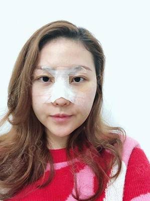 假体隆鼻眼睛周围肿了