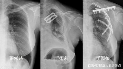 肋骨骨折需要怎么治疗