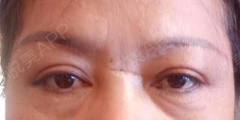 上眼皮往下掉