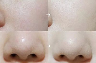 脸油长痘痘用什么散粉