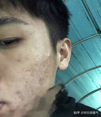 男生脸的两侧长痘痘的原因