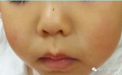 宝宝脸上有虫斑怎么办