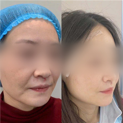 玻尿酸除皱美容效果