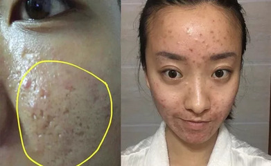痘印和痘疤