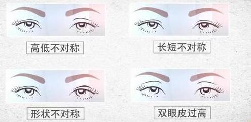 双眼皮风险