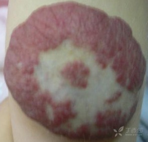 新生儿血管瘤