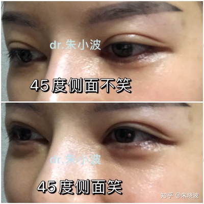 用玻尿酸打卧蚕的视频