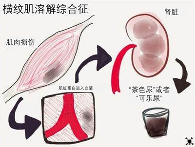 小便茶色是怎么回事