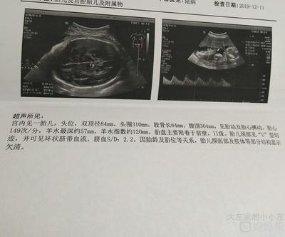 足月胎儿股骨长标准