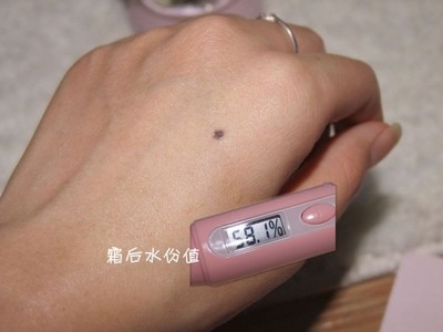 手背疤痕怎么去除