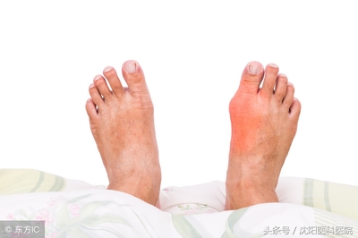 痛风会疼一个月吗