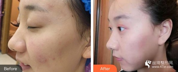 化了妆之后长痘痘