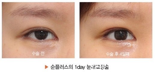 好看的内眦双眼皮
