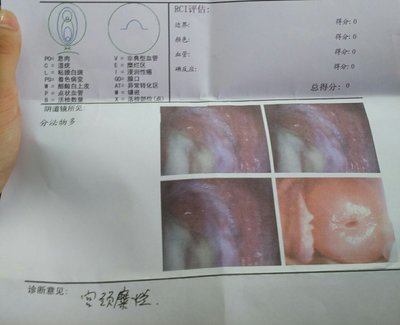 治宫颈糜烂手术价格多少费用