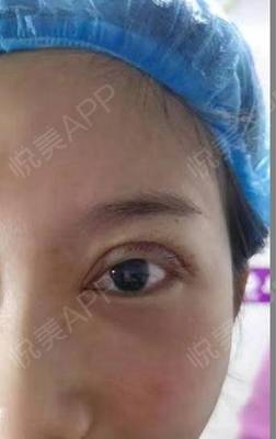 做双眼皮淤青多久能好