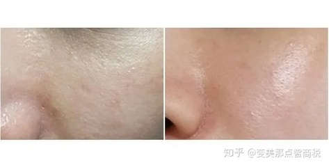 怎么样可以缩小毛孔