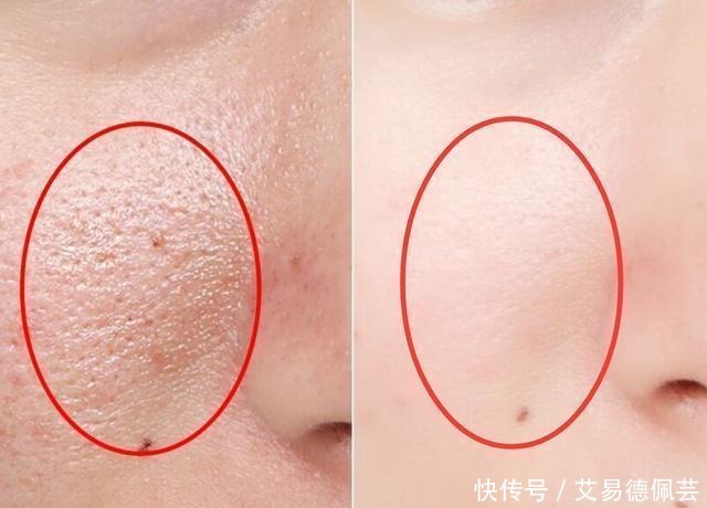 痘痘肌到底用不用面霜