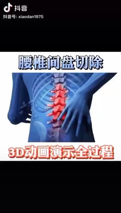 腰椎间盘突出怎么治疗最好