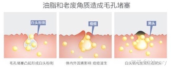 男生经常长痘痘要去角质吗