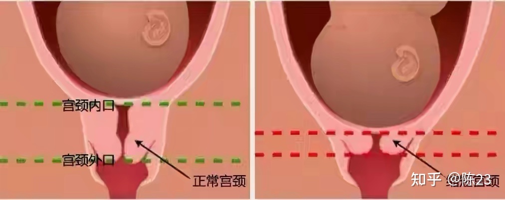 孕妇宫颈长度