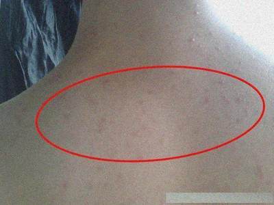 男人背上长痘痘用什么洗