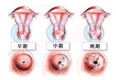 有宫颈糜烂会怀孕吗