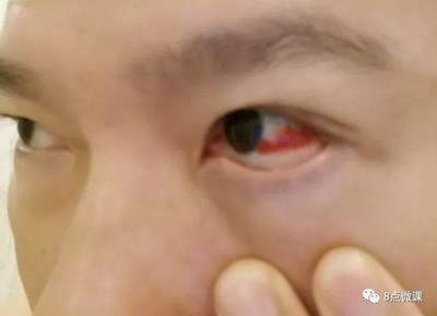 眼睛红是怎么回事