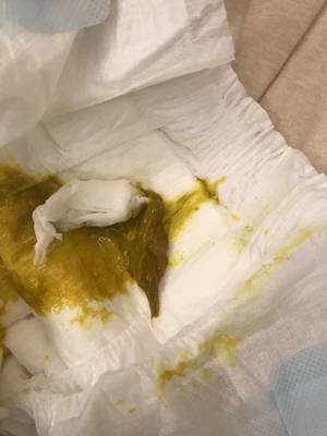 宝宝大便有块状物图片