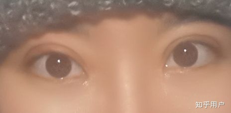 双眼皮刀疤多久能恢复