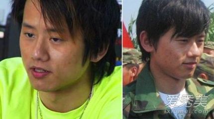 女性嘴巴周围长痘痘