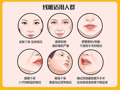 埋线提升脸