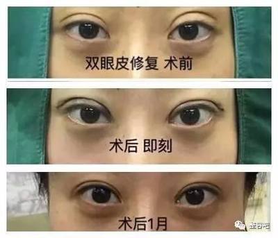 双眼皮自述