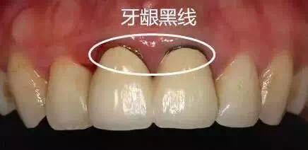 什么情况下做烤瓷牙