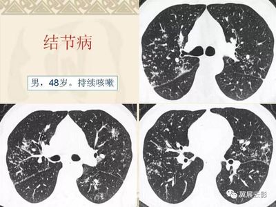 肺小结节会引起咳嗽吗