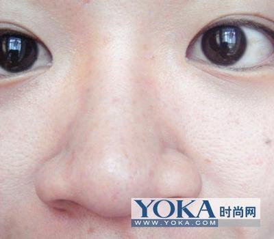 两颊长小痘痘是什么原因