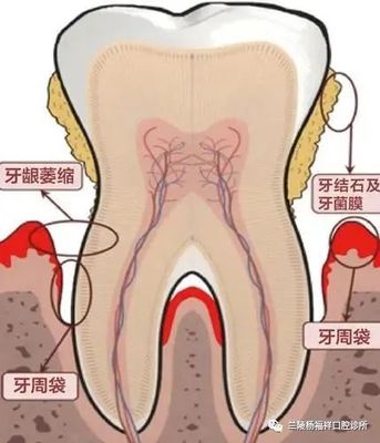 牙周炎早期怎么治疗