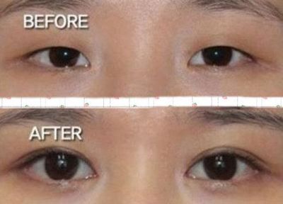 那些眼睛不适合开眼角