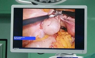 宫腹腔镜通输卵管手术多少钱
